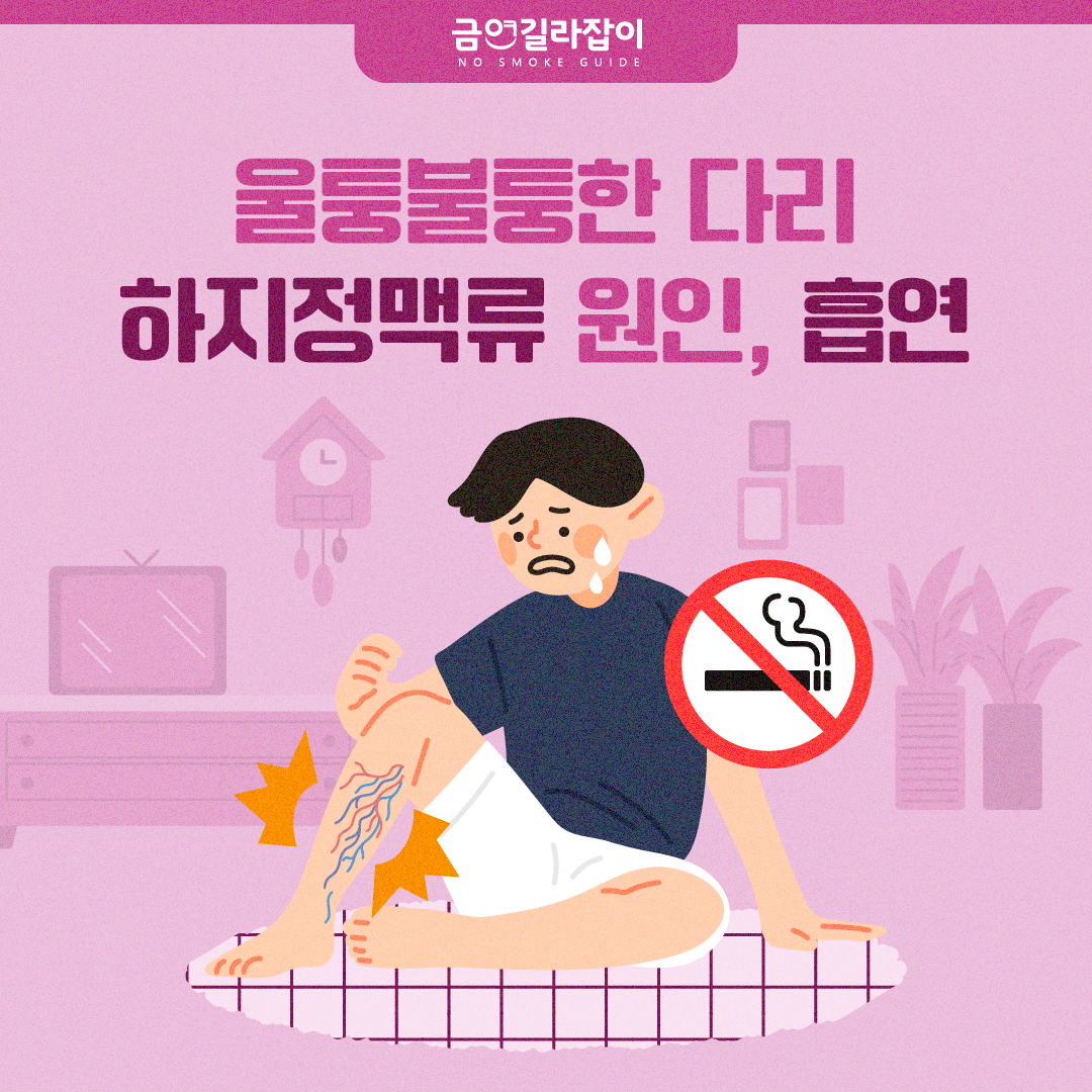 [카드뉴스] 울퉁불퉁한 다리 하지정맥류 원인 흡연 1