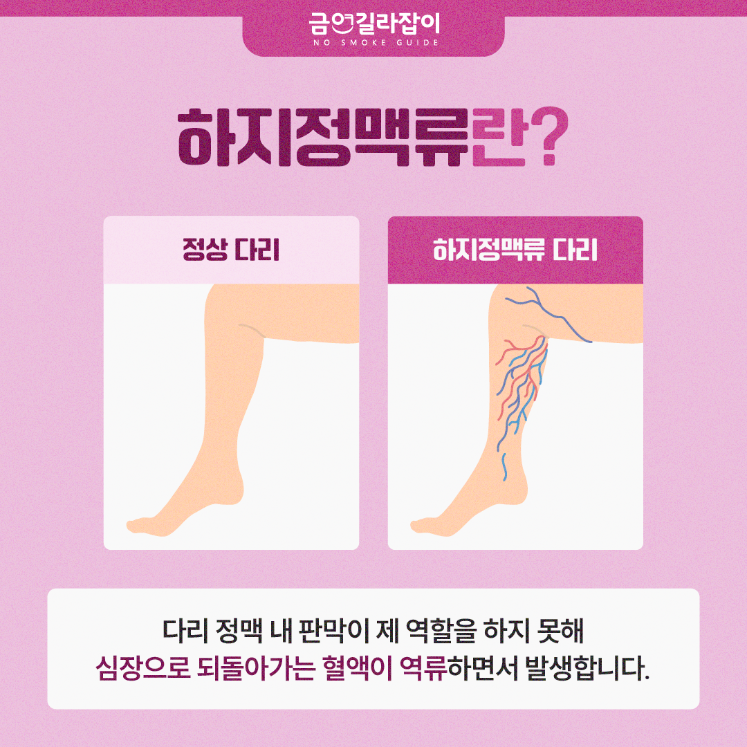 [카드뉴스] 울퉁불퉁한 다리 하지정맥류 원인 흡연 2